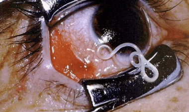 Aarte vu Parasiten am mënschleche Kierper